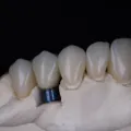 Dental Implant